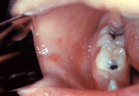 Koplik spots — white buccal spots pathognomonic of measles