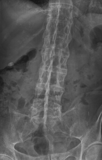 'Bamboo spine' — syndesmophytes fusing the spine in ankylosing spondylitis (X-ray)