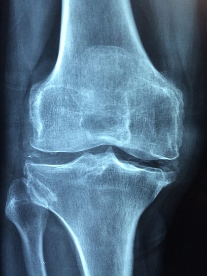 Chondrocalcinosis — calcification of knee cartilage (X-ray)