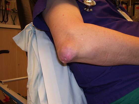 Gouty tophus over the elbow (olecranon)