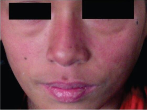 Malar (butterfly) rash of systemic lupus erythematosus