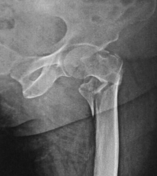 Comminuted hip (neck-of-femur) fracture (X-ray)