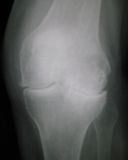 Osteoarthritis of the knee — joint-space loss, osteophytes and subchondral sclerosis (X-ray)