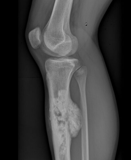 Osteosarcoma of the tibia — aggressive periosteal reaction (X-ray)