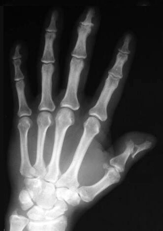 Psoriatic arthritis — erosive change of the interphalangeal joints (hand X-ray)