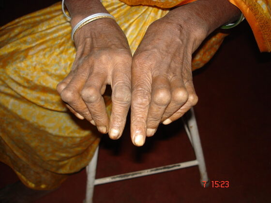 Rheumatoid arthritis — ulnar deviation and small-joint deformity of the hands