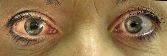 Acute angle-closure glaucoma — red eye, hazy cornea, mid-dilated pupil