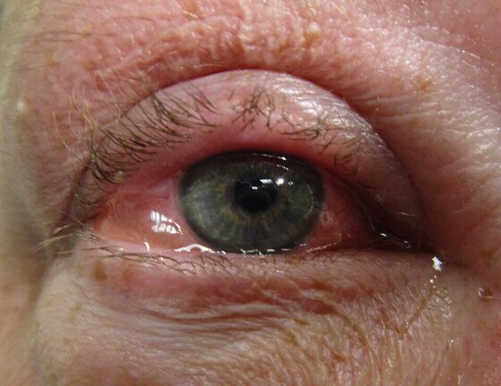 Allergic conjunctivitis — chemosis and conjunctival injection