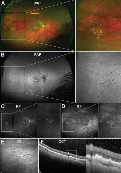 Age-related macular degeneration — macular drusen