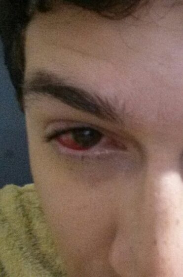 Bacterial conjunctivitis — purulent discharge, injected conjunctiva