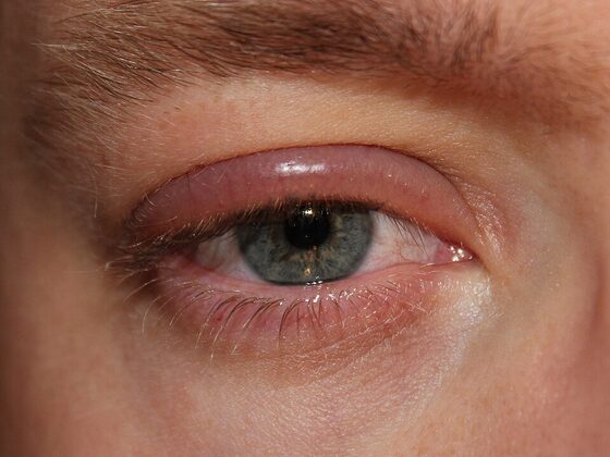 Blepharitis — crusting and inflammation of the lid margins