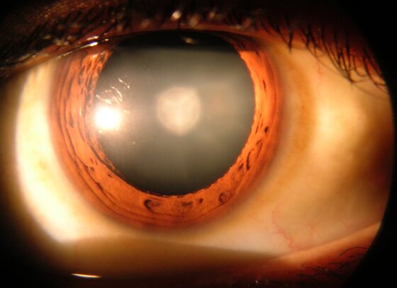 Cataract — opacified crystalline lens