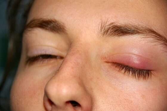 Chalazion — painless tarsal meibomian cyst
