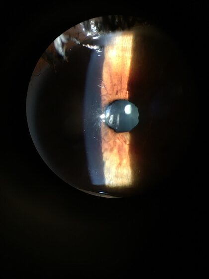 Congenital cataract — leukocoria (white pupil)