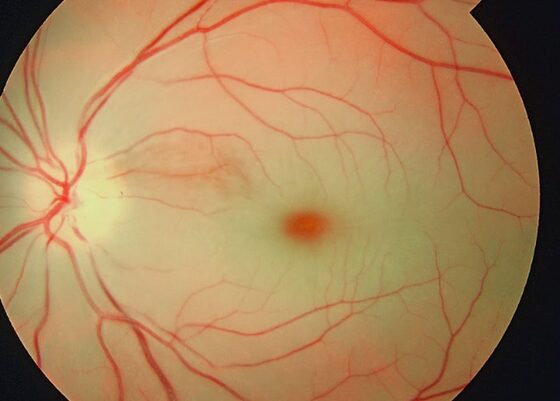 CRAO — pale retina with a cherry-red spot at the macula