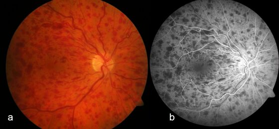 CRVO — widespread 'blood and thunder' retinal haemorrhages