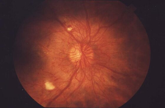 Proliferative diabetic retinopathy — neovascularisation and haemorrhages