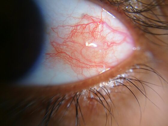 Episcleritis — sectoral superficial injection