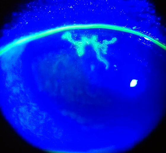 HSV keratitis — branching dendritic ulcer on fluorescein