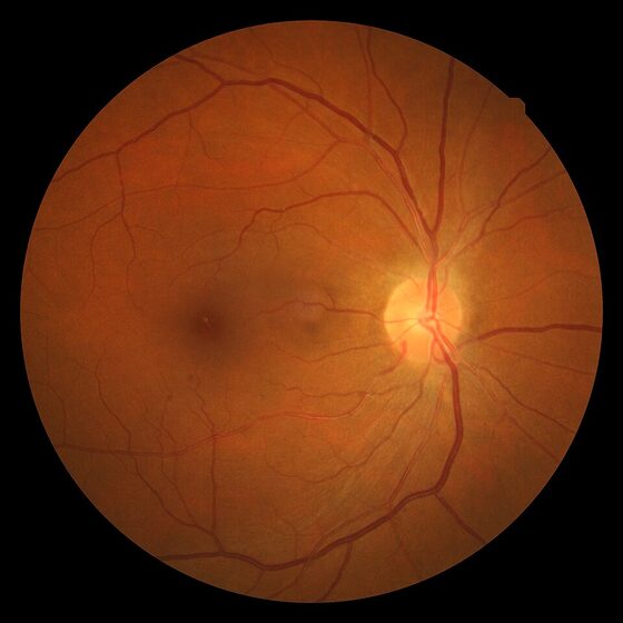 Hypertensive retinopathy — AV nipping, haemorrhages, cotton-wool spots