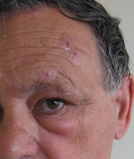 Herpes zoster ophthalmicus — V1 dermatomal vesicular rash (Hutchinson sign)
