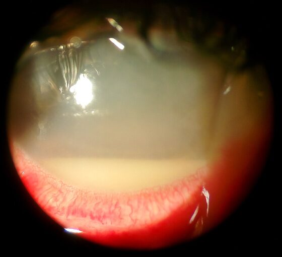 Microbial keratitis — corneal infiltrate with a hypopyon