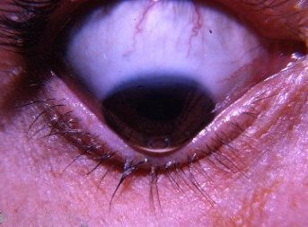 Keratoconus — conical cornea (Munson sign on downgaze)
