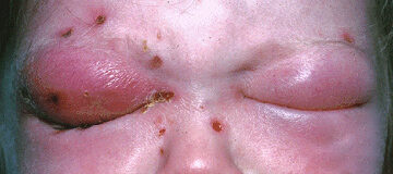 Orbital cellulitis — lid swelling, erythema and proptosis