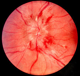 Papilloedema — optic-disc swelling with blurred margins
