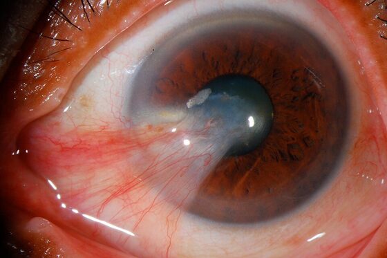 Pterygium — fibrovascular growth extending onto the cornea