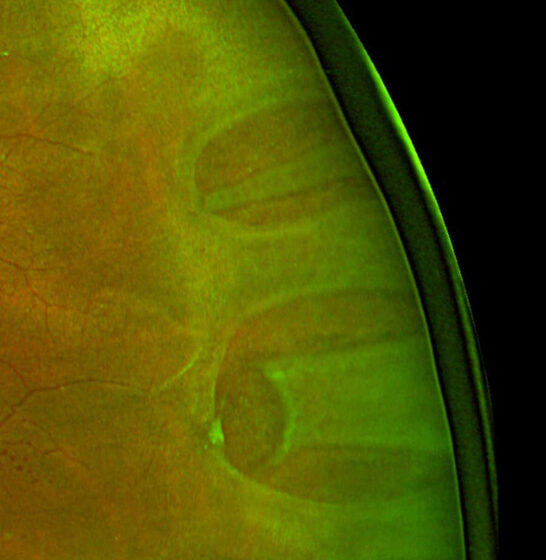 Rhegmatogenous retinal detachment — elevated detached retina