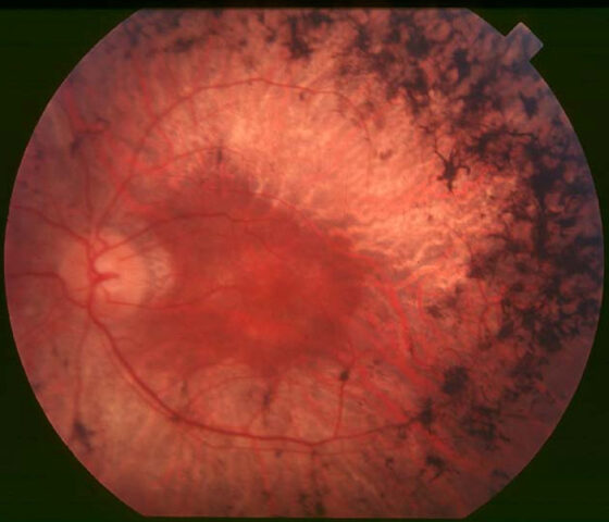 Retinitis pigmentosa — bone-spicule pigmentation and attenuated vessels