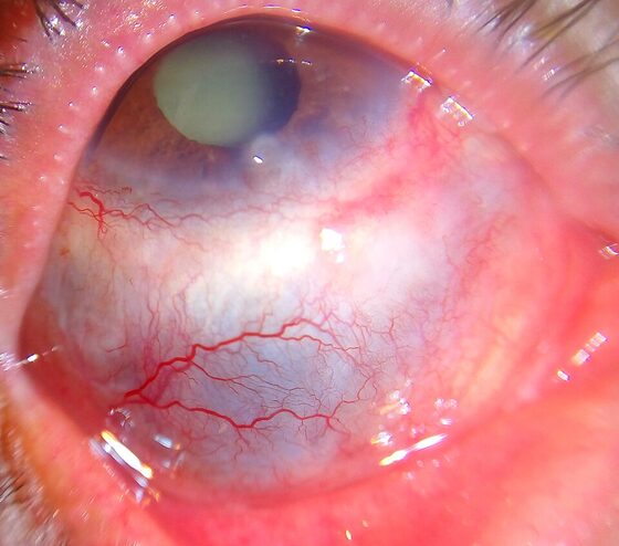 Scleritis — deep, violaceous scleral injection
