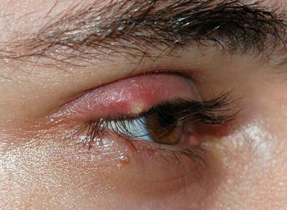 External stye — tender lesion pointing at the lash line