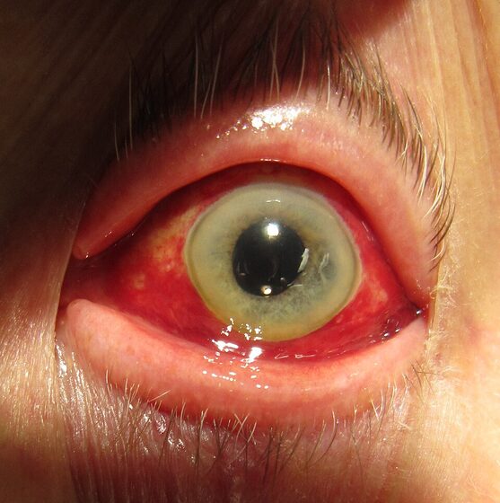 Subconjunctival haemorrhage — flat, well-demarcated blood under the conjunctiva