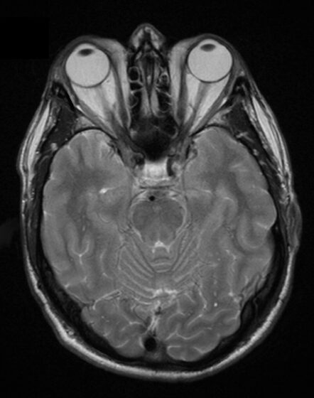 Thyroid eye disease — MRI showing enlarged extraocular muscles