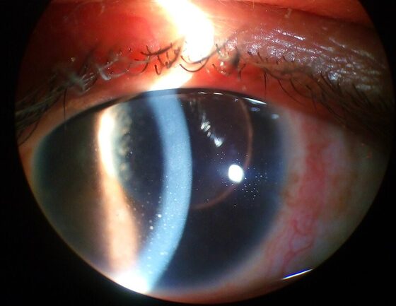 Anterior uveitis — keratic precipitates on the corneal endothelium