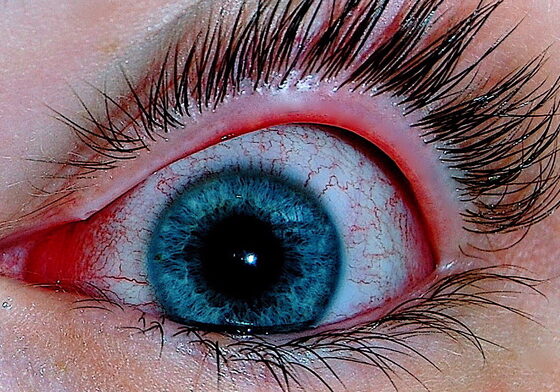 Viral (adenoviral) conjunctivitis — watery red eye