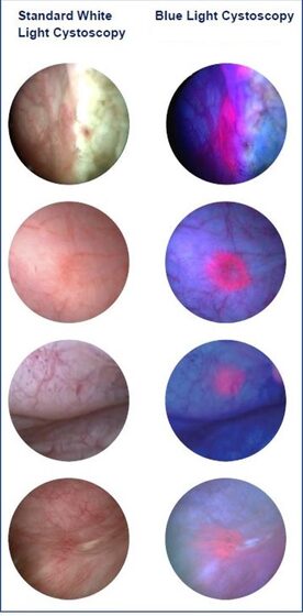 Bladder tumour seen at cystoscopy (white-light and blue-light)