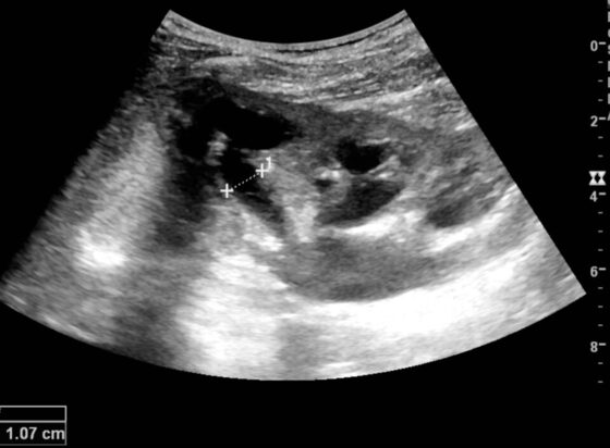 Hydronephrosis — dilated anechoic renal pelvis and calyces on ultrasound