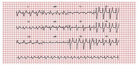 Hyperkalaemia — peaked (tented) T waves on the ECG