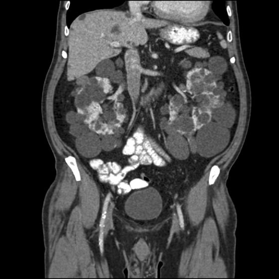 Autosomal dominant polycystic kidney disease — innumerable bilateral renal cysts (CT)