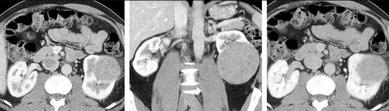 Renal cell carcinoma — enhancing renal mass on contrast CT