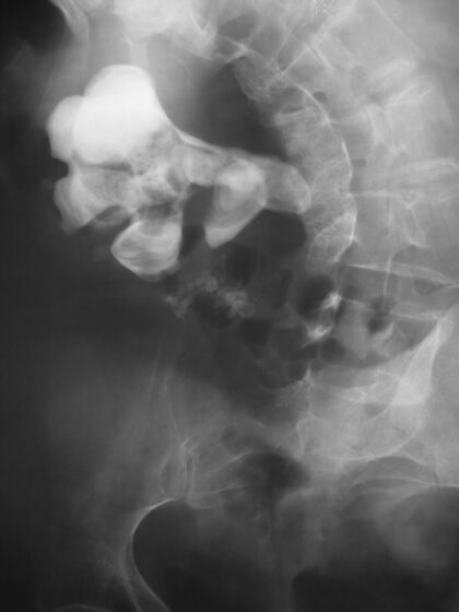 Staghorn calculus filling the renal collecting system (abdominal X-ray)