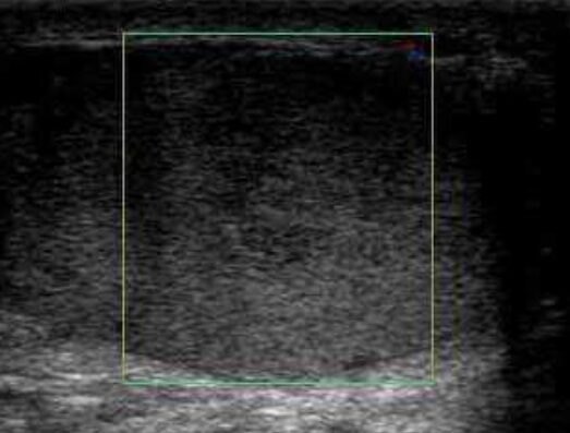 Testicular torsion — abnormal testicular perfusion on scrotal ultrasound