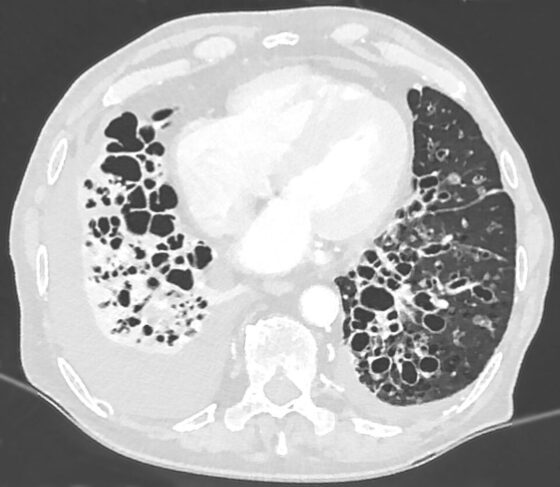 Bronchiectasis — dilated, thick-walled bronchi on CT