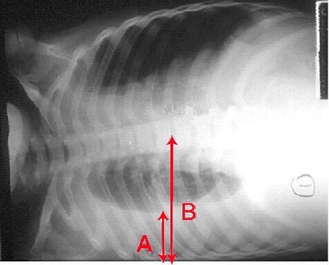Pleural effusion — blunting of the costophrenic angle with a meniscus (chest X-ray)