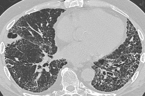 Usual interstitial pneumonia — peripheral/basal honeycombing on HRCT