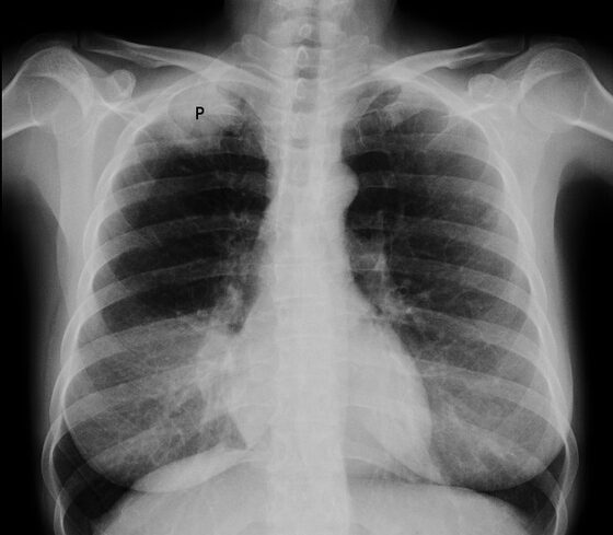 Pancoast (apical) lung tumour on chest X-ray