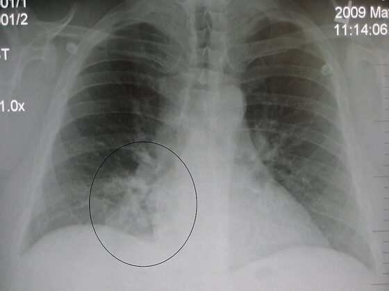 Right lower lobe consolidation (pneumonia) on chest X-ray